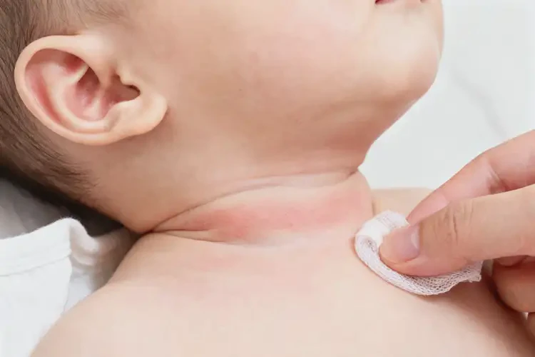 嬰幼兒脖子偶爾長(zhǎng)濕疹可以治好嗎(圖4)