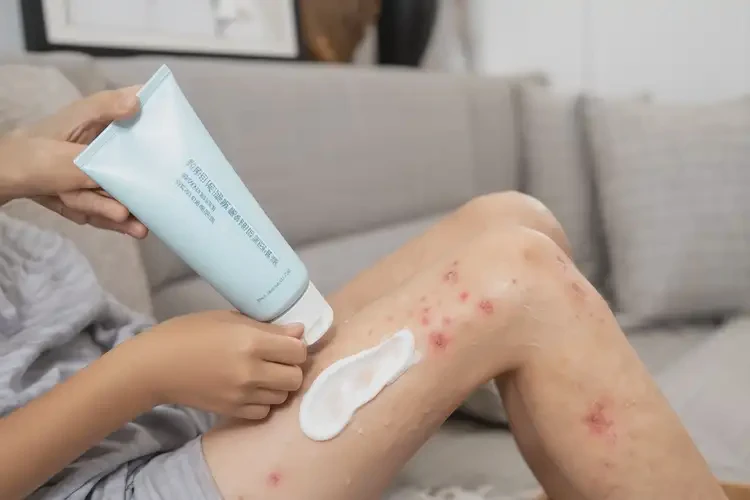 青少年大腿上出現(xiàn)濕疹可不可以根治(圖2)