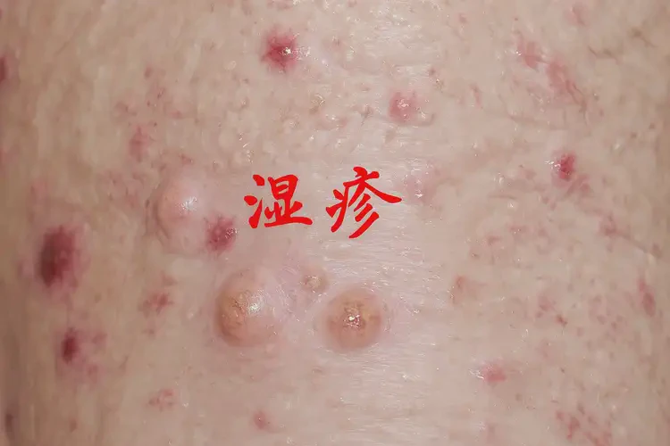 男生肛周容易起濕疹可以治好嗎(圖4)