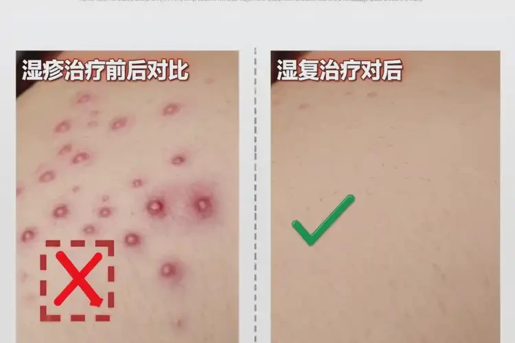 男性全身出現(xiàn)濕疹可以治好嗎(圖4)