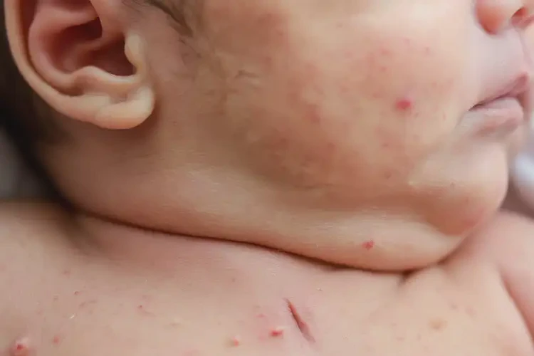 新生兒脖子上長濕疹可以治好嗎(圖4)