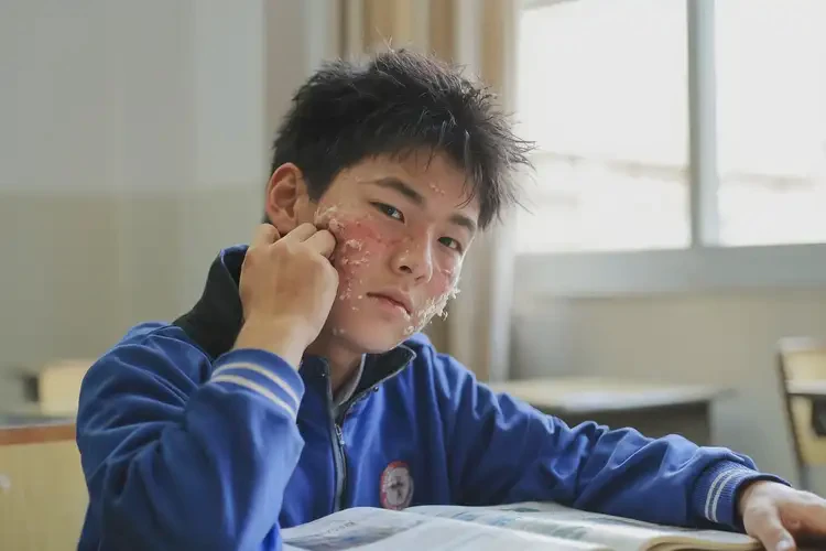 中学生面部出现湿疹可不可以根治(图4)