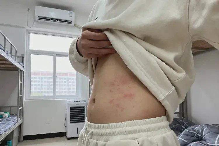大學(xué)生肚子有濕疹能徹底自愈嗎(圖2)