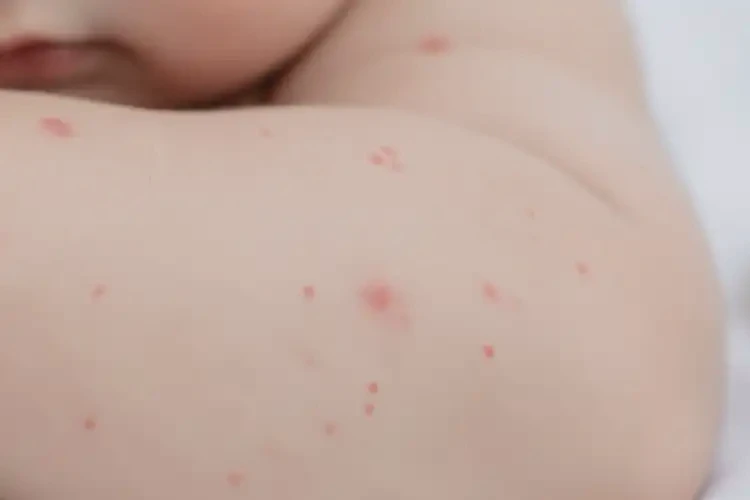 幼兒屁股偶爾起濕疹可不可以根治(圖4)