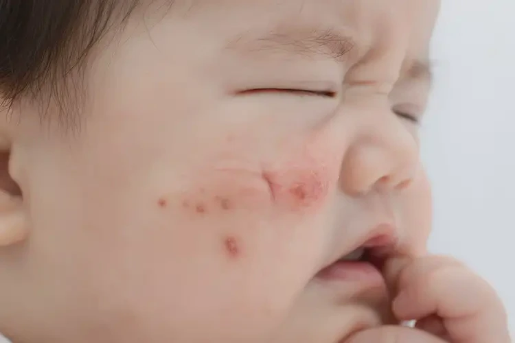 嬰幼兒身上容易長濕疹不管它會自己自愈嗎(圖4)