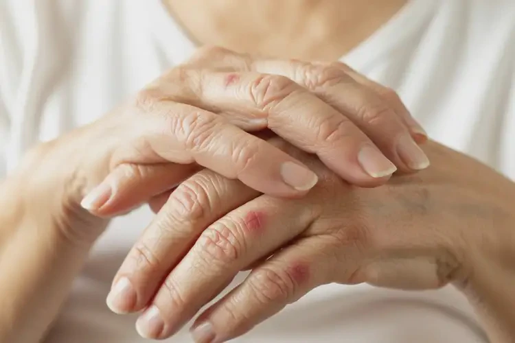 高齡老人身上偶爾長濕疹可不可以根治(圖2)