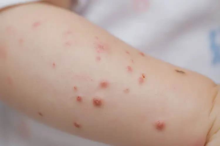 幼兒手臂上長濕疹可以治好嗎(圖4)