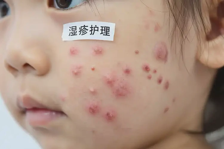 孩子面部出現(xiàn)濕疹可以治好嗎(圖4)