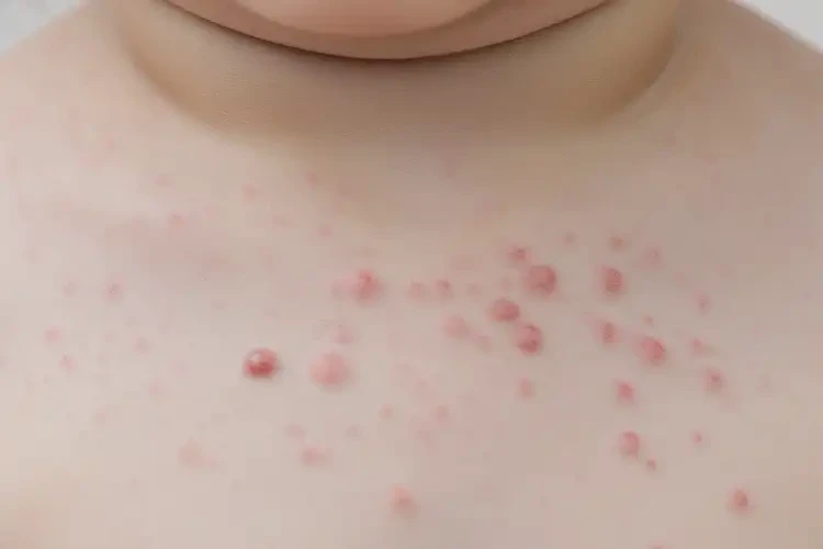 孩子脖子上容易起濕疹可以治好嗎(圖4)