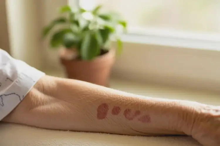 老人手臂起濕疹可以治好嗎(圖4)