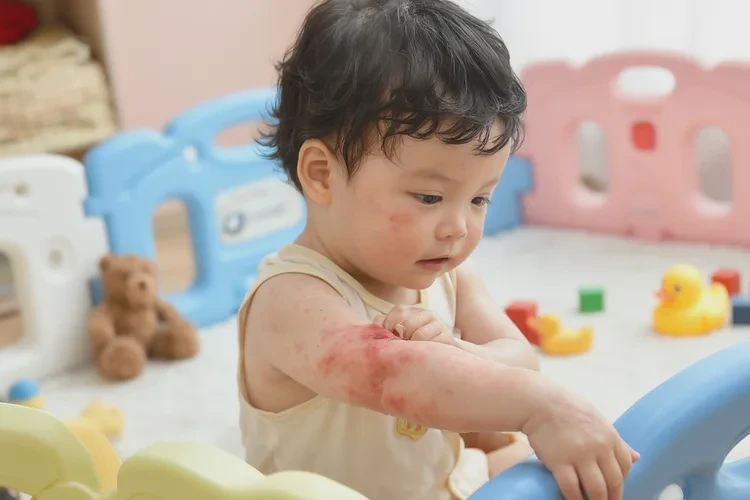 嬰幼兒屁股上有濕疹可以治愈嗎(圖2)