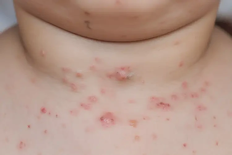 幼兒脖子上有濕疹可不可以根治(圖4)