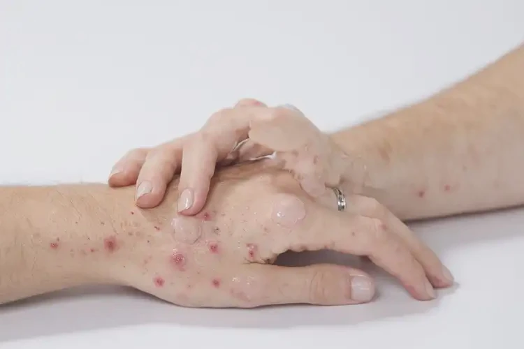 女生手上经常起湿疹可不可以彻底自愈(图4)
