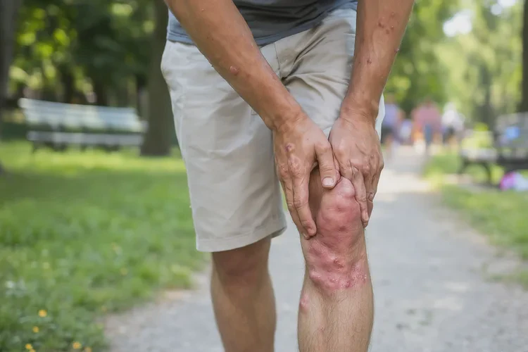 青年人四肢偶爾起濕疹能靠自己自愈嗎(圖2)