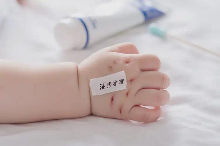 寶寶手上容易長(zhǎng)濕疹可以治好嗎(圖4)