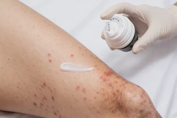 男性大腿容易長(zhǎng)濕疹可以治好嗎(圖3)