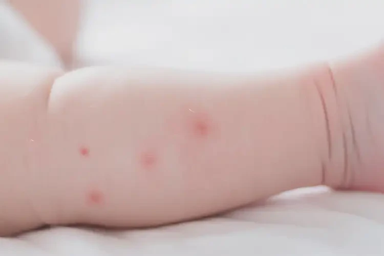 新生儿小腿上容易起湿疹能靠自己自愈吗(图3)