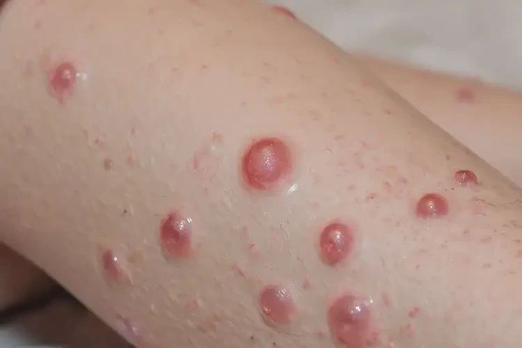 少兒大腿偶爾長濕疹可以治好嗎(圖4)