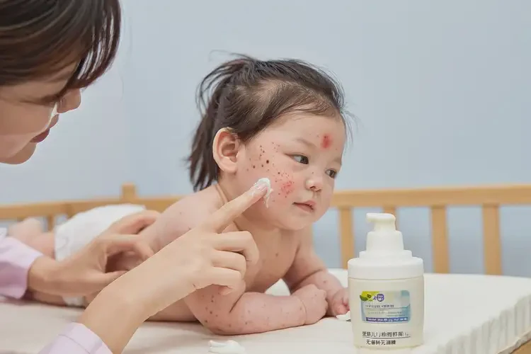 寶寶身上經(jīng)常起濕疹可以治好嗎(圖3)