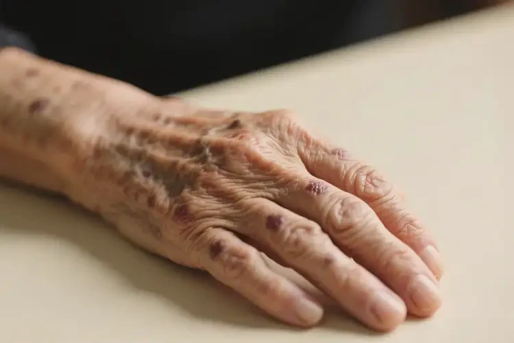 老人手臂上偶爾長濕疹可以治好嗎(圖3)