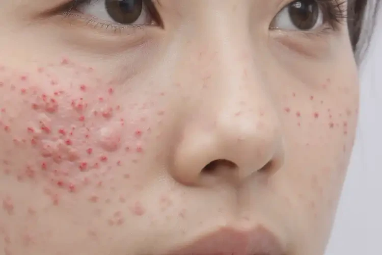 女人屁股上長濕疹能徹底自愈嗎(圖4)