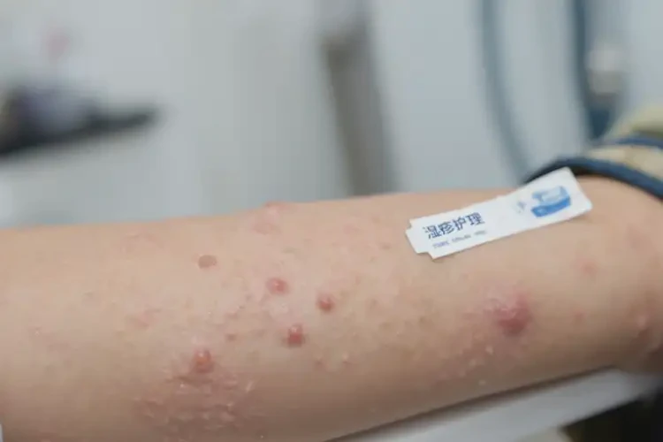 少兒手臂上起濕疹可以治好嗎(圖4)