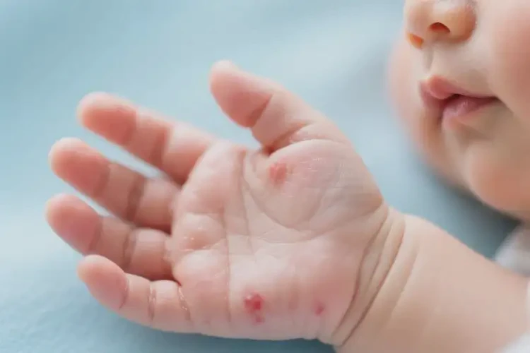新生兒手上經(jīng)常長濕疹可以治好嗎(圖4)
