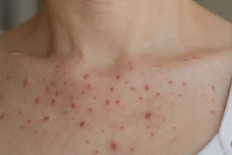 女性脖子容易起濕疹可以治好嗎(圖4)