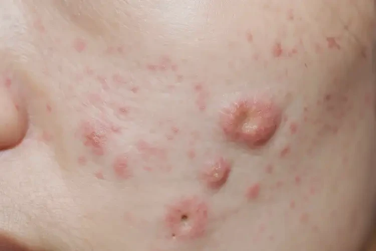 男人脖子上容易起濕疹可以治好嗎(圖4)