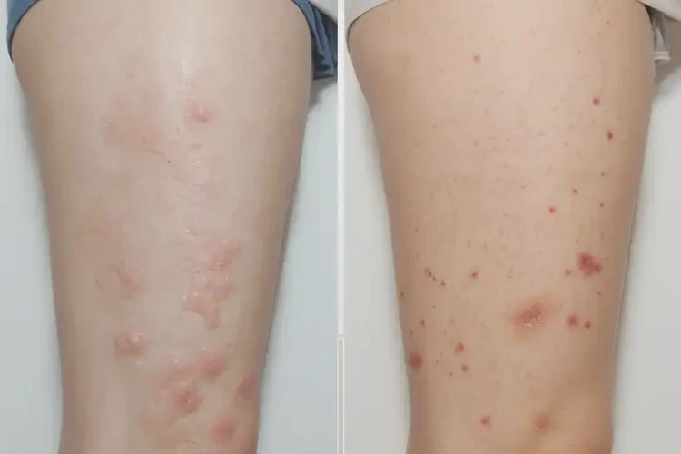 孕妇大腿上经常起湿疹可以治好吗(图2)