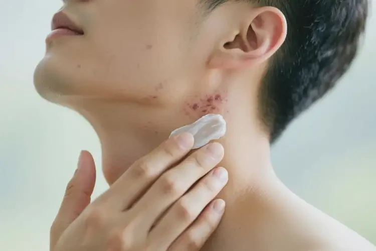 男性脖子偶爾長濕疹可以治好嗎(圖3)