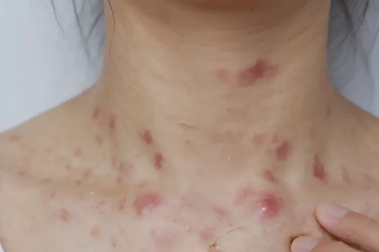 女生脖子上长湿疹可以治好吗(图4)