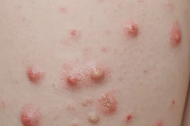 小兒大腿上偶爾長(zhǎng)濕疹可不可以徹底自愈(圖4)