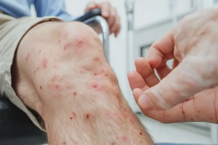 男性小腿上出濕疹可以治好嗎(圖4)