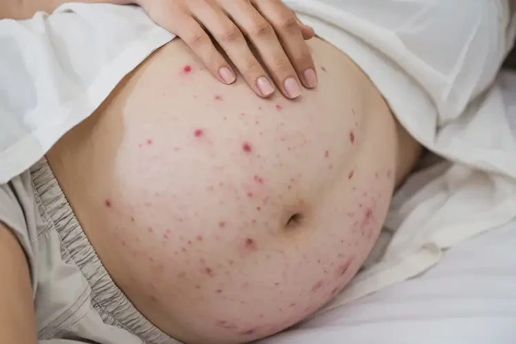 孕婦肚子出現(xiàn)濕疹可以治好嗎(圖4)