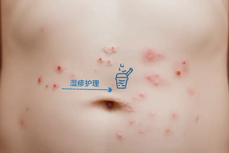 小孩肚子上容易長濕疹能夠徹底治愈嗎(圖4)