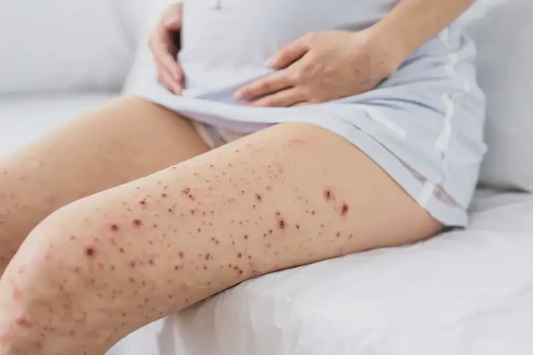 孕妇大腿上经常起湿疹可以治好吗(图4)