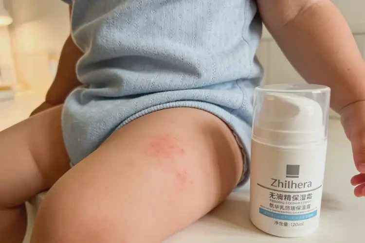 幼儿大腿偶尔起湿疹可以治好吗(图1)