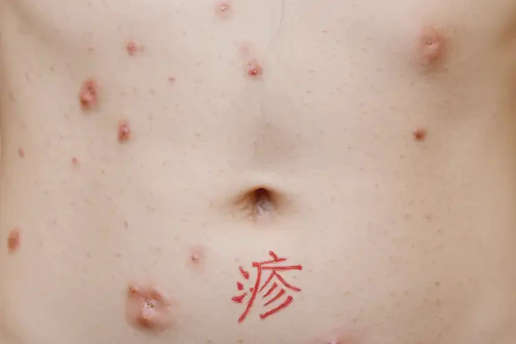 中學(xué)生肚子上長濕疹可以治好嗎(圖4)