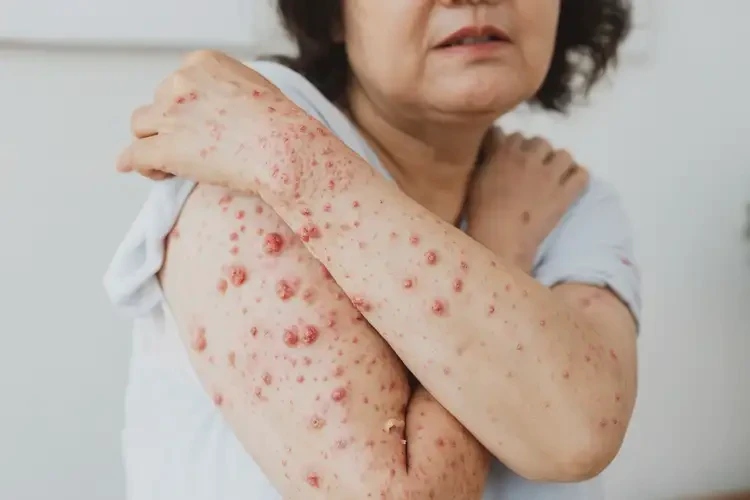 女性手臂經(jīng)常起濕疹可以治好嗎(圖4)