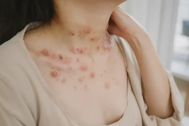 孕婦脖子容易長(zhǎng)濕疹可以治好嗎(圖4)