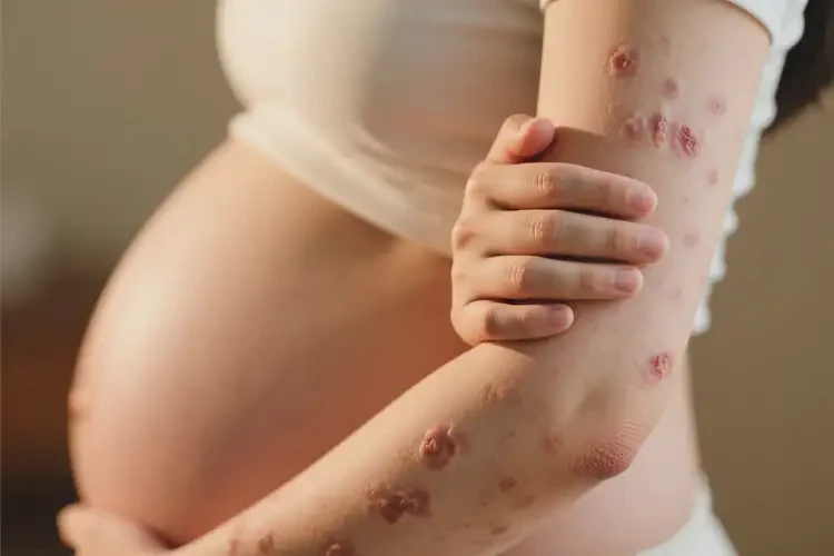 产妇手臂上容易长湿疹可以治好吗(图1)