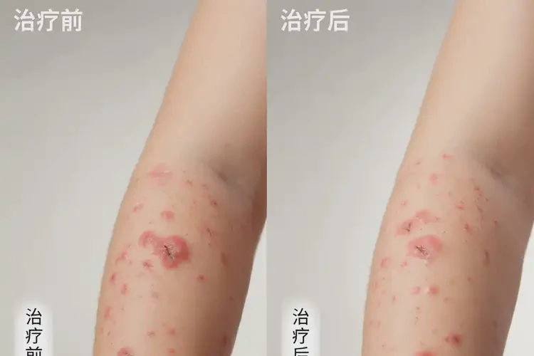 小學(xué)生手臂上出濕疹可以治好嗎(圖1)