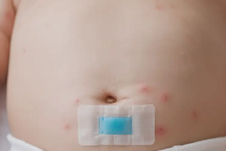 寶寶肚子上容易起濕疹可以治好嗎(圖4)