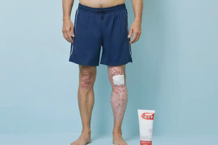 男人小腿上經(jīng)常起濕疹可不可以根治(圖3)