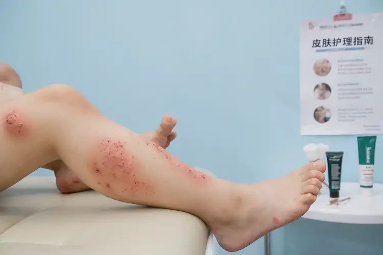 儿童小腿上经常长湿疹可以治好吗(图2)