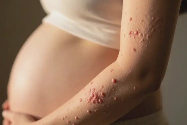 产妇手臂上容易长湿疹可以治好吗(图4)