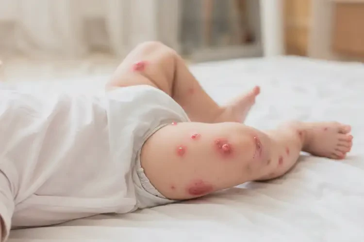 寶寶四肢出濕疹可以治好嗎(圖4)