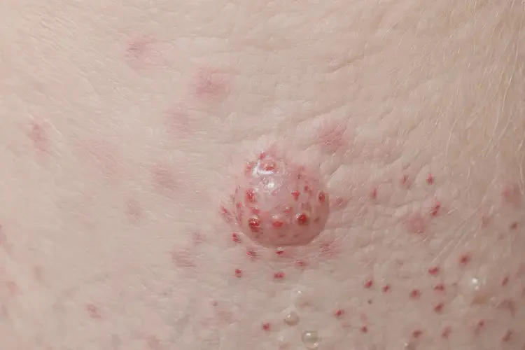 男性身上容易长湿疹不管它会自己自愈吗(图4)