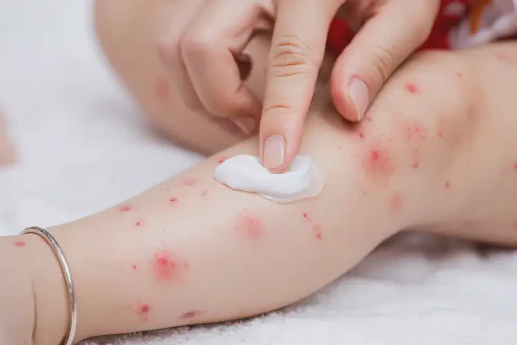 寶寶小腿上出現(xiàn)濕疹可以治好嗎(圖3)